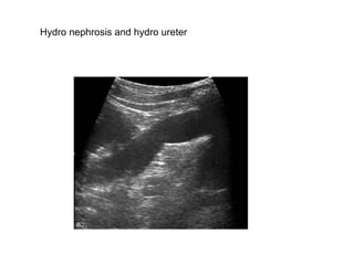 Hydro nephrosis and hydro ureter  