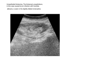 Uroepithelial thickening. The thickened uroepithelium,  in this case caused by an infection with Candida albicans, is seen in the slightly dilated renal pelvis.   