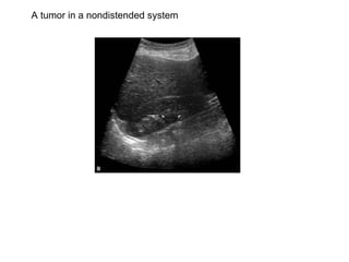 A tumor in a nondistended system  
