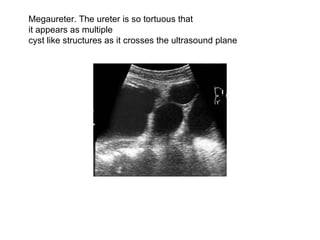Megaureter. The ureter is so tortuous that it appears as multiple  cyst like structures as it crosses the ultrasound plane  