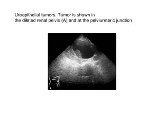 Uroepithelial tumors. Tumor is shown in  the dilated renal pelvis (A) and at the pelviureteric junction  