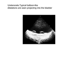 Ureterocele.Typical balloon-like  dilatations are seen projecting into the bladder  