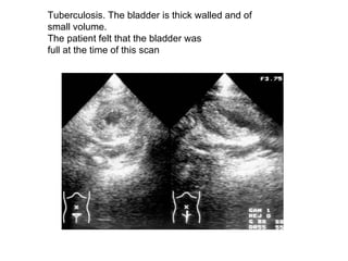 Tuberculosis. The bladder is thick walled and of  small volume.  The patient felt that the bladder was  full at the time of this scan  