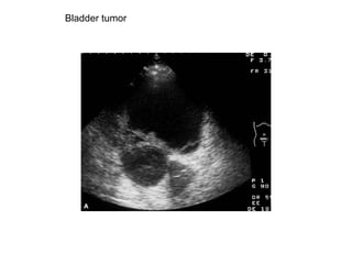 Bladder tumor  