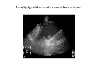 A small polypoidal tumor with a narrow base is shown.  