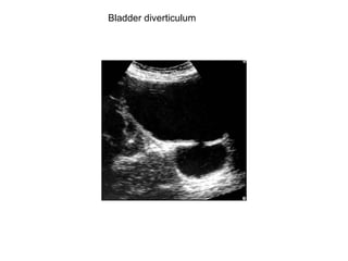 Bladder diverticulum  