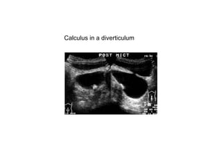 Calculus in a diverticulum  