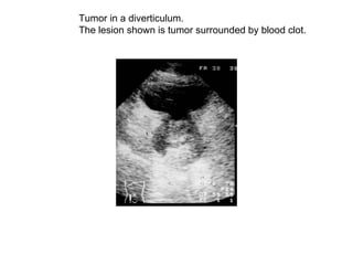 Tumor in a diverticulum.  The lesion shown is tumor surrounded by blood clot.  