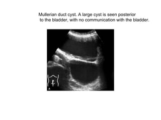 Mullerian duct cyst. A large cyst is seen posterior to the bladder, with no communication with the bladder.  