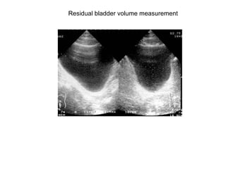 Residual bladder volume measurement  