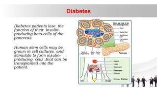 Diabetes patients lose the
function of their insulin-
producing beta cells of the
pancreas.
Human stem cells may be
grown in cell cultures and
stimulate to form insulin-
producing cells ,that can be
transplanted into the
patient.
Diabetes
 