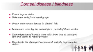 Corneal disease / blindness
 Result in poor vision.
 Take stem cells from healthy eye.
 Grown onto contact lenses in clinical lab.
 Lenses are worn by the patient for a period of three weeks.
 Then migration of human stem cells from lens to damaged
eye and begin to repair process.
 Thus heals the damaged cornea and quickly improves the
vision.
 