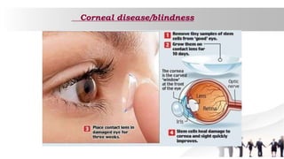 Corneal disease/blindness
 