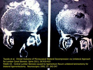 Lumbar Spinal Stenosis ULBD technique | PPTX