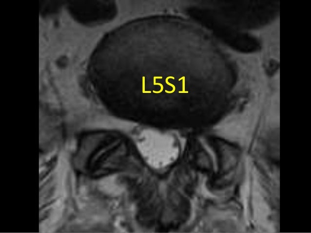 synovial cyst spine synovial cyst spine