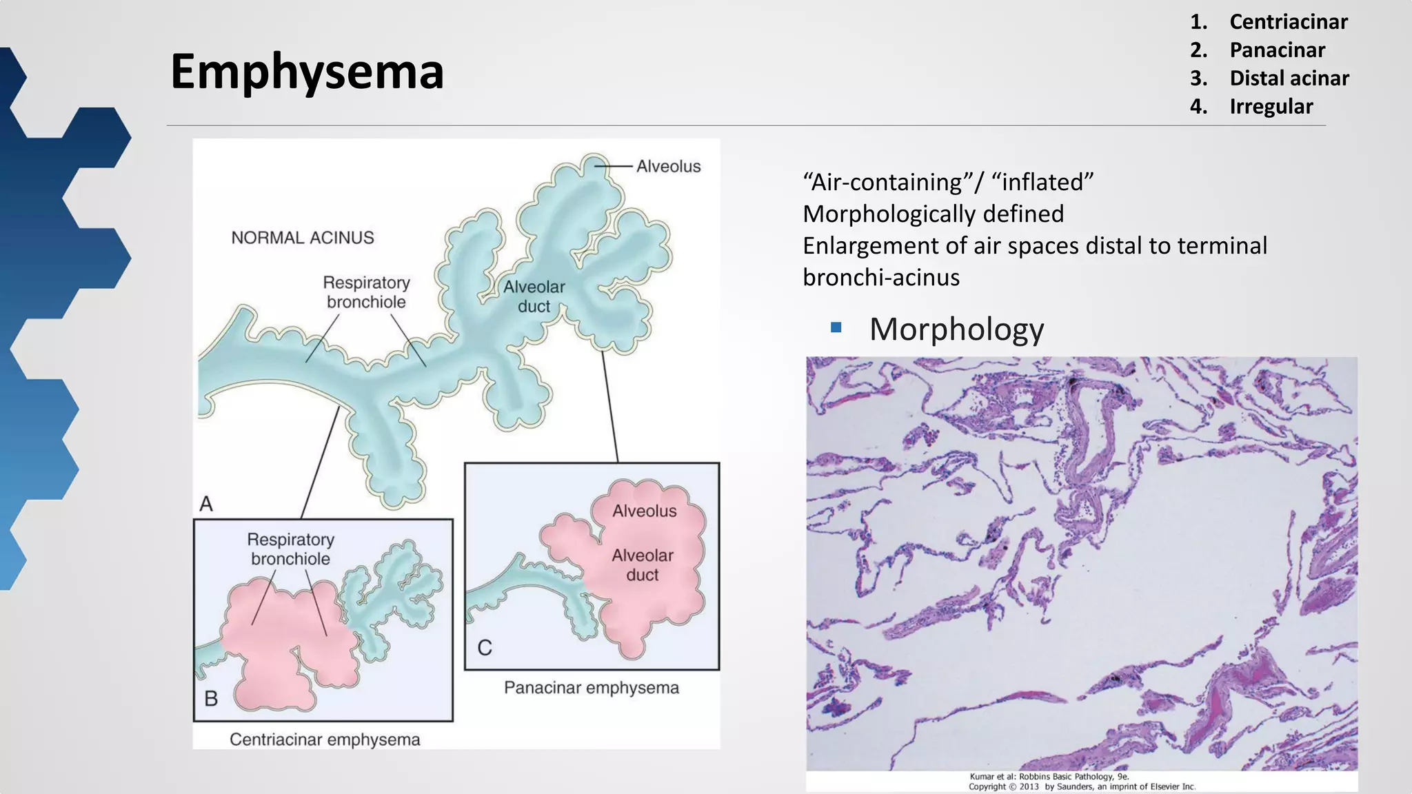 13
Emphysema
“Air-containing”/ “inflated”
Morphologically defined
Enlargement of air spaces distal to terminal
bronchi-acinus
1. Centriacinar
2. Panacinar
3. Distal acinar
4. Irregular
 Morphology
 