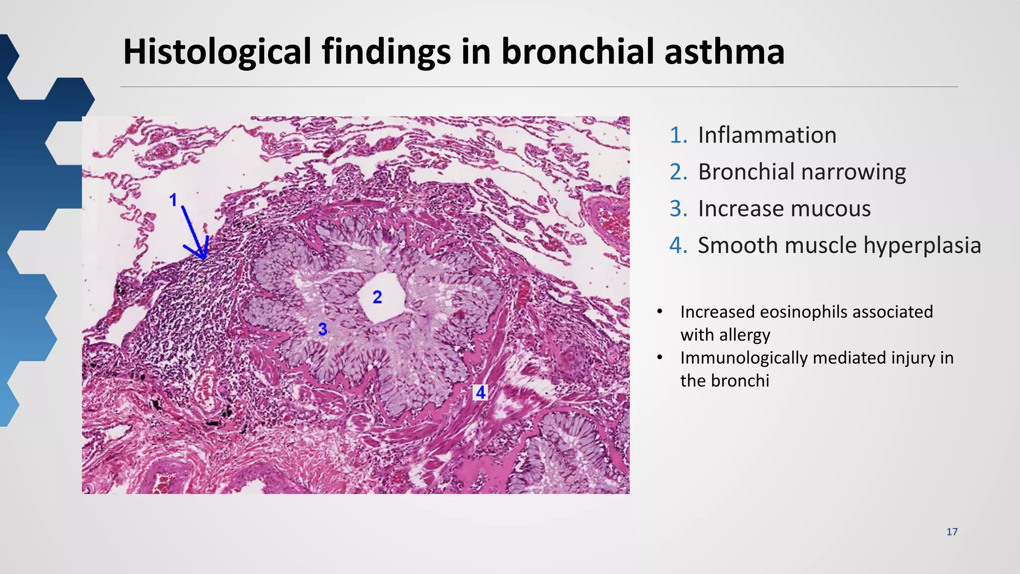17
Histological findings in bronchial asthma
1. Inflammation
2. Bronchial narrowing
3. Increase mucous
4. Smooth muscle hyperplasia
• Increased eosinophils associated
with allergy
• Immunologically mediated injury in
the bronchi
 