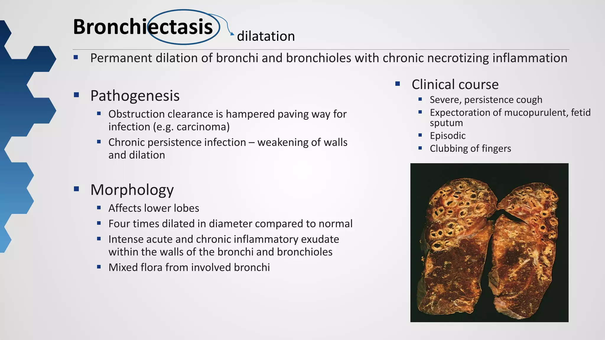 19
Bronchiectasis
 Permanent dilation of bronchi and bronchioles with chronic necrotizing inflammation
dilatation
 Pathogenesis
 Obstruction clearance is hampered paving way for
infection (e.g. carcinoma)
 Chronic persistence infection – weakening of walls
and dilation
 Morphology
 Affects lower lobes
 Four times dilated in diameter compared to normal
 Intense acute and chronic inflammatory exudate
within the walls of the bronchi and bronchioles
 Mixed flora from involved bronchi
 Clinical course
 Severe, persistence cough
 Expectoration of mucopurulent, fetid
sputum
 Episodic
 Clubbing of fingers
 