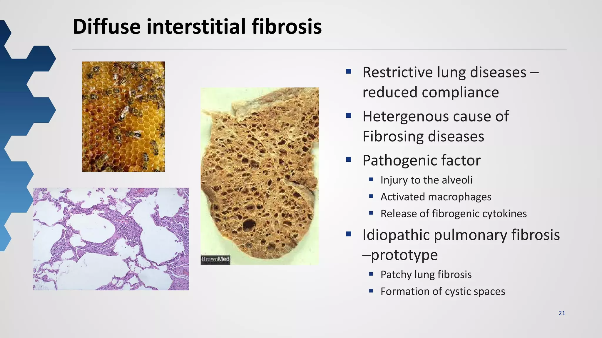 21
Diffuse interstitial fibrosis
 Restrictive lung diseases –
reduced compliance
 Hetergenous cause of
Fibrosing diseases
 Pathogenic factor
 Injury to the alveoli
 Activated macrophages
 Release of fibrogenic cytokines
 Idiopathic pulmonary fibrosis
–prototype
 Patchy lung fibrosis
 Formation of cystic spaces
 