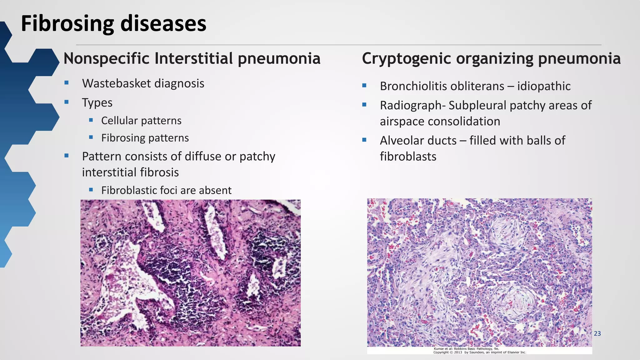 23
Fibrosing diseases
Nonspecific Interstitial pneumonia Cryptogenic organizing pneumonia
 Wastebasket diagnosis
 Types
 Cellular patterns
 Fibrosing patterns
 Pattern consists of diffuse or patchy
interstitial fibrosis
 Fibroblastic foci are absent
 Bronchiolitis obliterans – idiopathic
 Radiograph- Subpleural patchy areas of
airspace consolidation
 Alveolar ducts – filled with balls of
fibroblasts
 