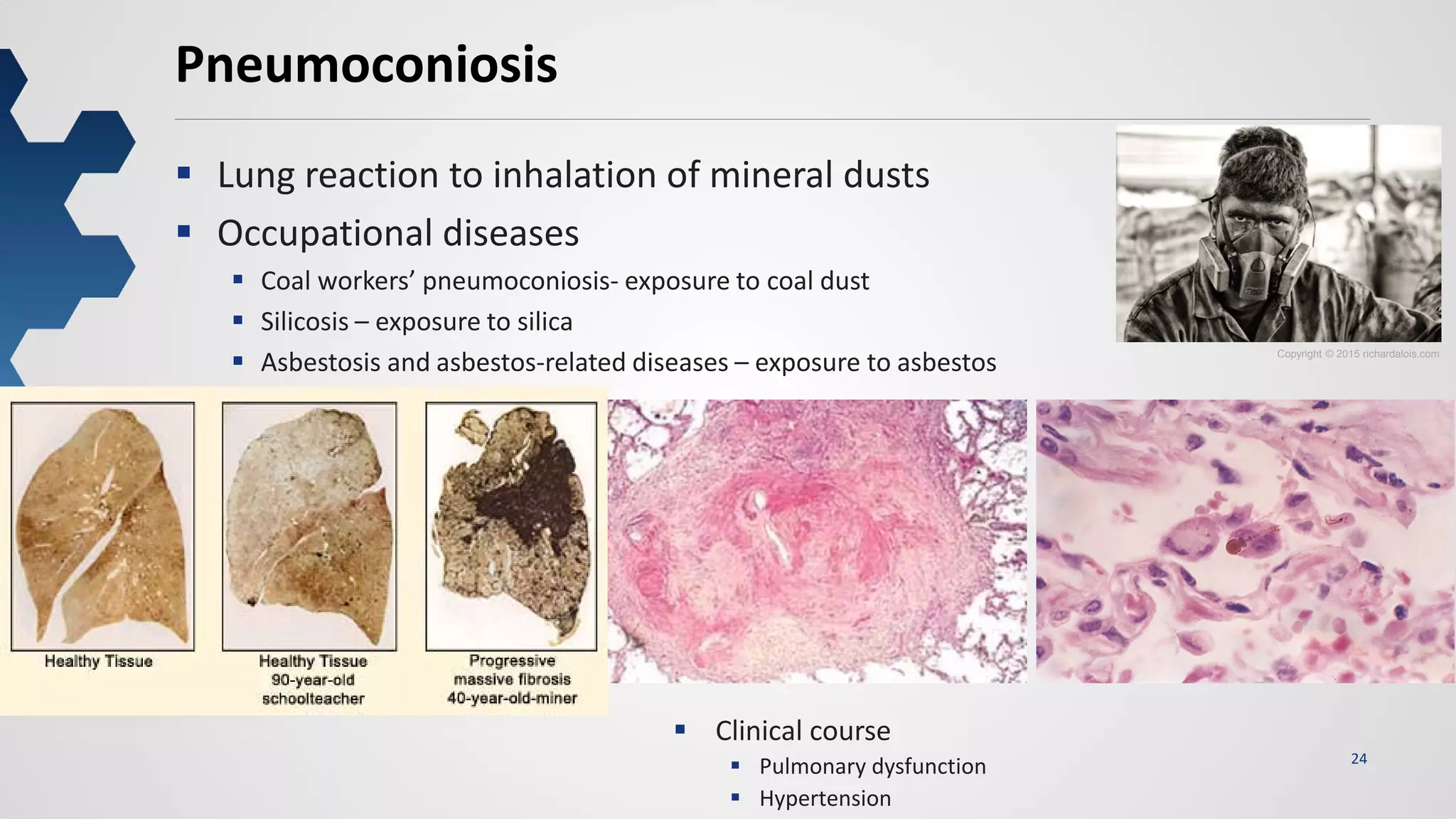 24
Pneumoconiosis
 Lung reaction to inhalation of mineral dusts
 Occupational diseases
 Coal workers’ pneumoconiosis- exposure to coal dust
 Silicosis – exposure to silica
 Asbestosis and asbestos-related diseases – exposure to asbestos Copyright © 2015 richardalois.com
 Clinical course
 Pulmonary dysfunction
 Hypertension
 