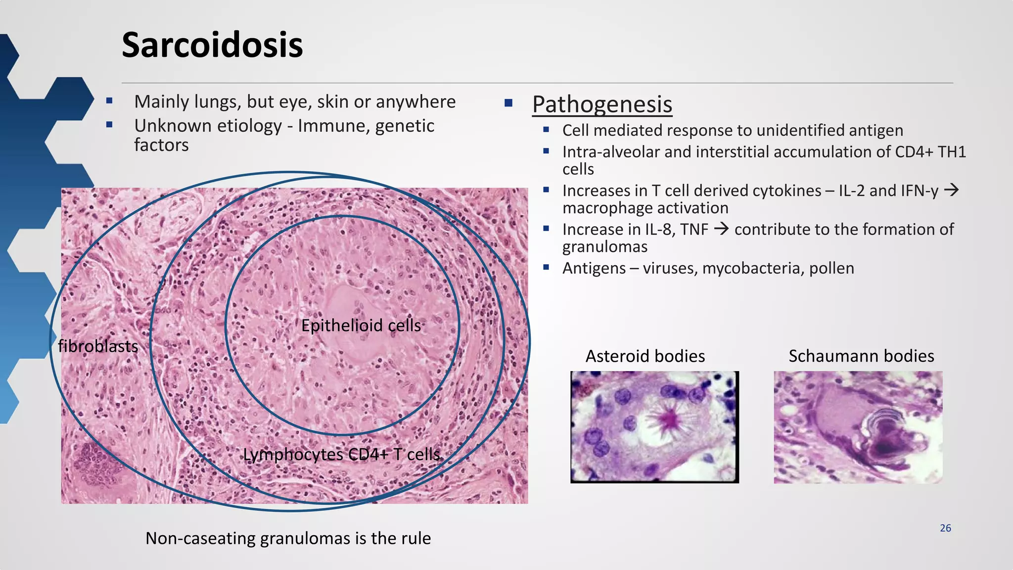 26
Sarcoidosis
 Mainly lungs, but eye, skin or anywhere
 Unknown etiology - Immune, genetic
factors
 Pathogenesis
 Cell mediated response to unidentified antigen
 Intra-alveolar and interstitial accumulation of CD4+ TH1
cells
 Increases in T cell derived cytokines – IL-2 and IFN-y 
macrophage activation
 Increase in IL-8, TNF  contribute to the formation of
granulomas
 Antigens – viruses, mycobacteria, pollen
Epithelioid cells
Lymphocytes CD4+ T cells
fibroblasts
Non-caseating granulomas is the rule
Asteroid bodies Schaumann bodies
 