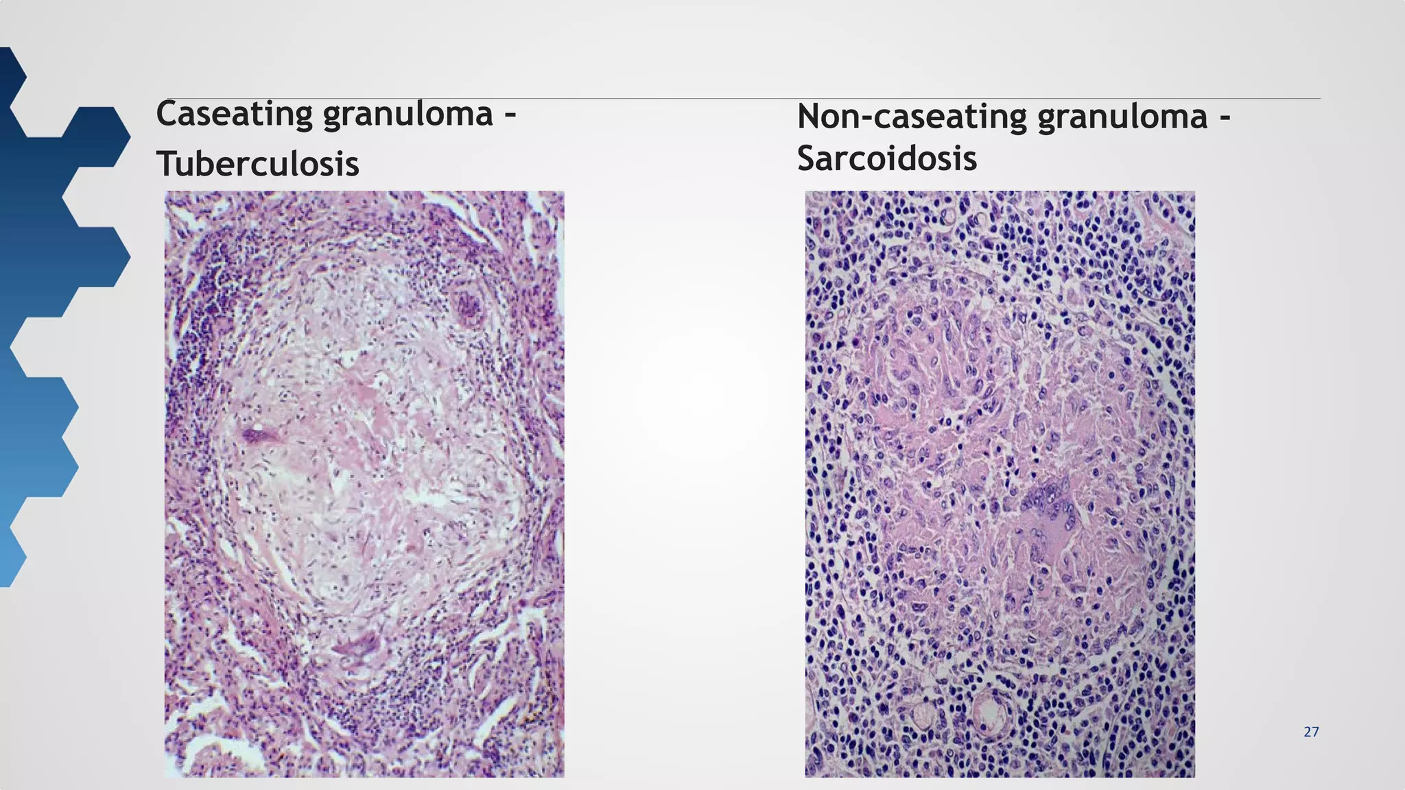 27
Caseating granuloma –
Tuberculosis
Non-caseating granuloma -
Sarcoidosis
 