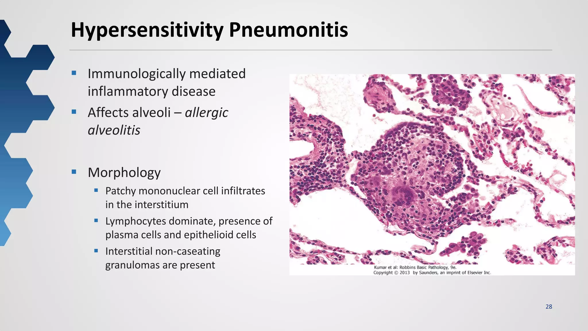 28
Hypersensitivity Pneumonitis
 Immunologically mediated
inflammatory disease
 Affects alveoli – allergic
alveolitis
 Morphology
 Patchy mononuclear cell infiltrates
in the interstitium
 Lymphocytes dominate, presence of
plasma cells and epithelioid cells
 Interstitial non-caseating
granulomas are present
 