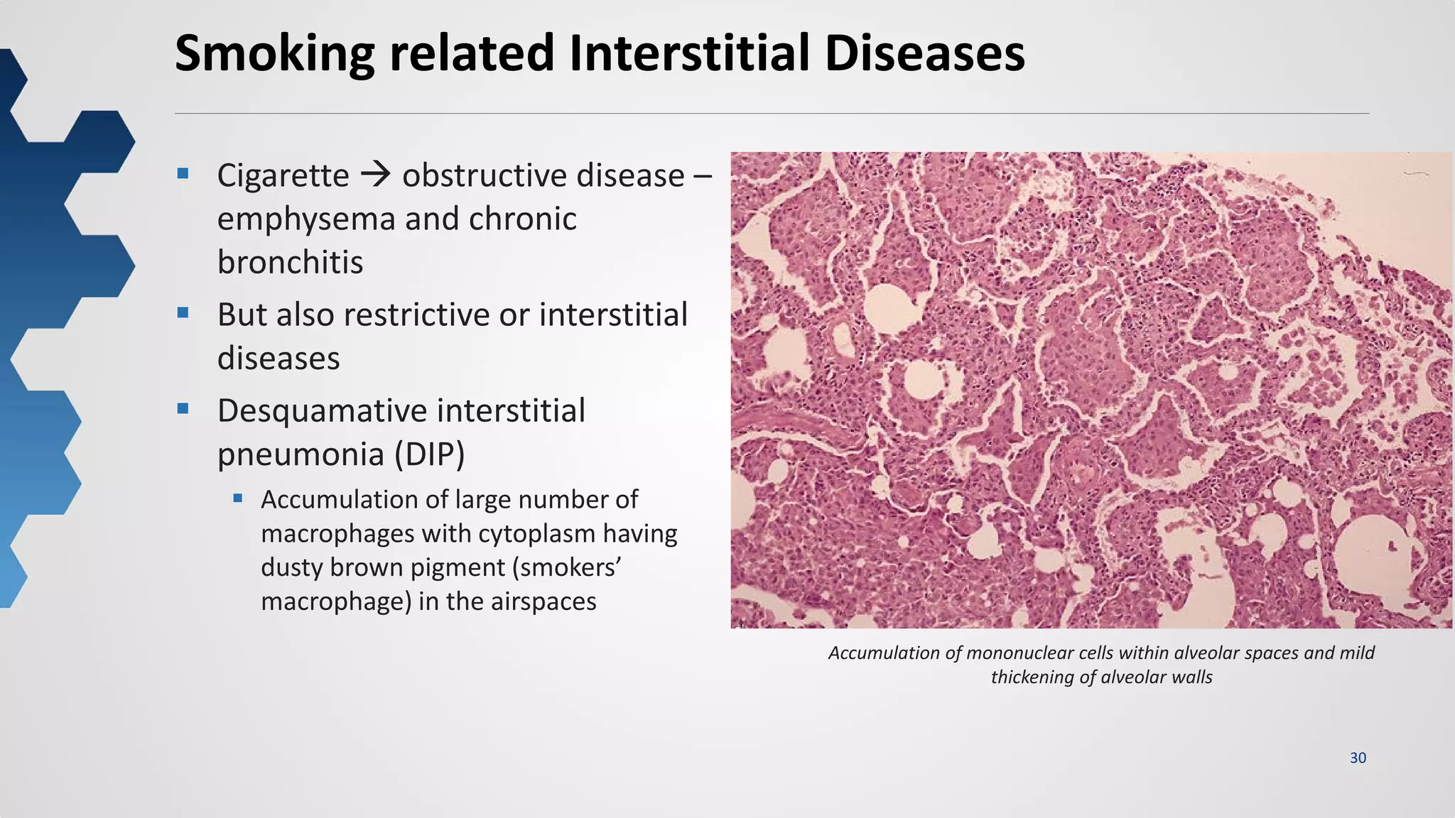 30
Smoking related Interstitial Diseases
 Cigarette  obstructive disease –
emphysema and chronic
bronchitis
 But also restrictive or interstitial
diseases
 Desquamative interstitial
pneumonia (DIP)
 Accumulation of large number of
macrophages with cytoplasm having
dusty brown pigment (smokers’
macrophage) in the airspaces
Accumulation of mononuclear cells within alveolar spaces and mild
thickening of alveolar walls
 