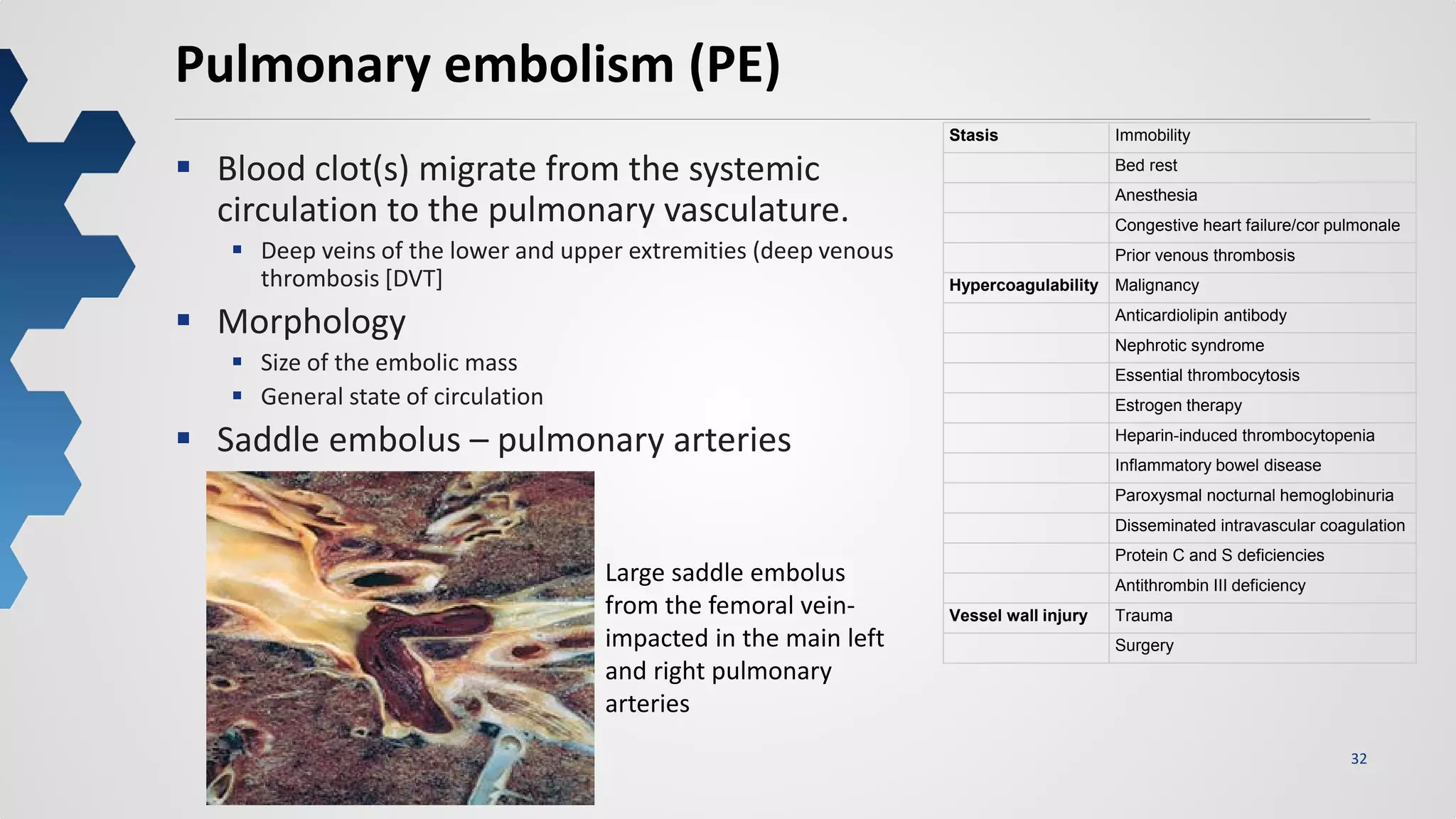 32
Pulmonary embolism (PE)
 Blood clot(s) migrate from the systemic
circulation to the pulmonary vasculature.
 Deep veins of the lower and upper extremities (deep venous
thrombosis [DVT]
 Morphology
 Size of the embolic mass
 General state of circulation
 Saddle embolus – pulmonary arteries
Stasis Immobility
Bed rest
Anesthesia
Congestive heart failure/cor pulmonale
Prior venous thrombosis
Hypercoagulability Malignancy
Anticardiolipin antibody
Nephrotic syndrome
Essential thrombocytosis
Estrogen therapy
Heparin-induced thrombocytopenia
Inflammatory bowel disease
Paroxysmal nocturnal hemoglobinuria
Disseminated intravascular coagulation
Protein C and S deficiencies
Antithrombin III deficiency
Vessel wall injury Trauma
Surgery
Large saddle embolus
from the femoral vein-
impacted in the main left
and right pulmonary
arteries
 