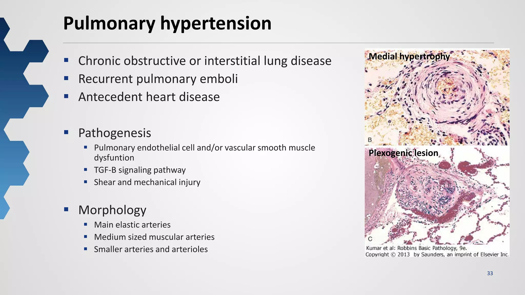 33
Pulmonary hypertension
 Chronic obstructive or interstitial lung disease
 Recurrent pulmonary emboli
 Antecedent heart disease
 Pathogenesis
 Pulmonary endothelial cell and/or vascular smooth muscle
dysfuntion
 TGF-B signaling pathway
 Shear and mechanical injury
 Morphology
 Main elastic arteries
 Medium sized muscular arteries
 Smaller arteries and arterioles
Medial hypertrophy
Plexogenic lesion
 