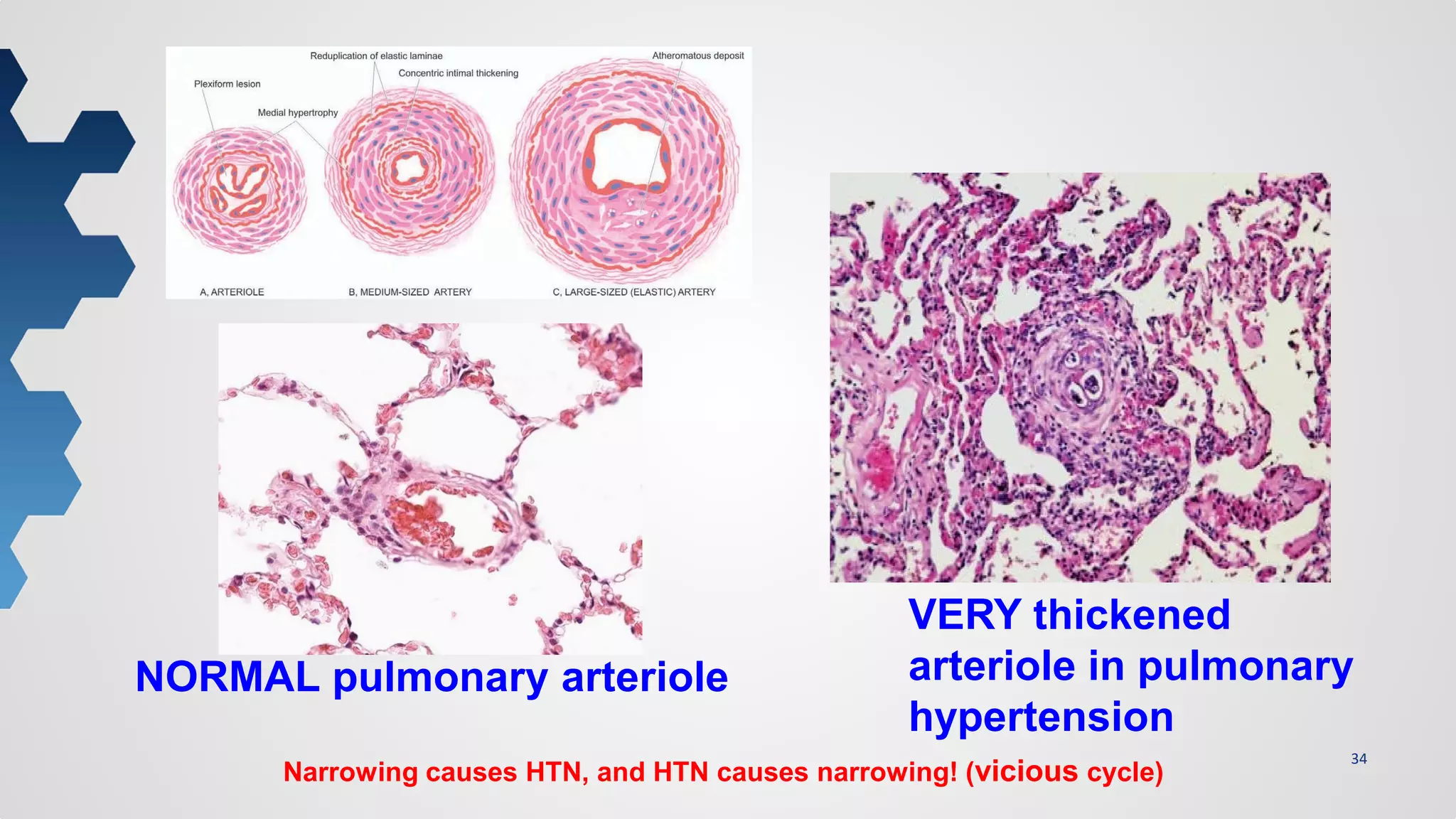 34
VERY thickened
arteriole in pulmonary
hypertension
NORMAL pulmonary arteriole
Narrowing causes HTN, and HTN causes narrowing! (vicious cycle)
 