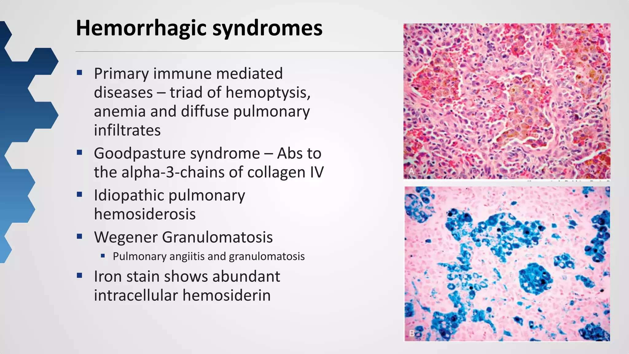 35
Hemorrhagic syndromes
 Primary immune mediated
diseases – triad of hemoptysis,
anemia and diffuse pulmonary
infiltrates
 Goodpasture syndrome – Abs to
the alpha-3-chains of collagen IV
 Idiopathic pulmonary
hemosiderosis
 Wegener Granulomatosis
 Pulmonary angiitis and granulomatosis
 Iron stain shows abundant
intracellular hemosiderin
 