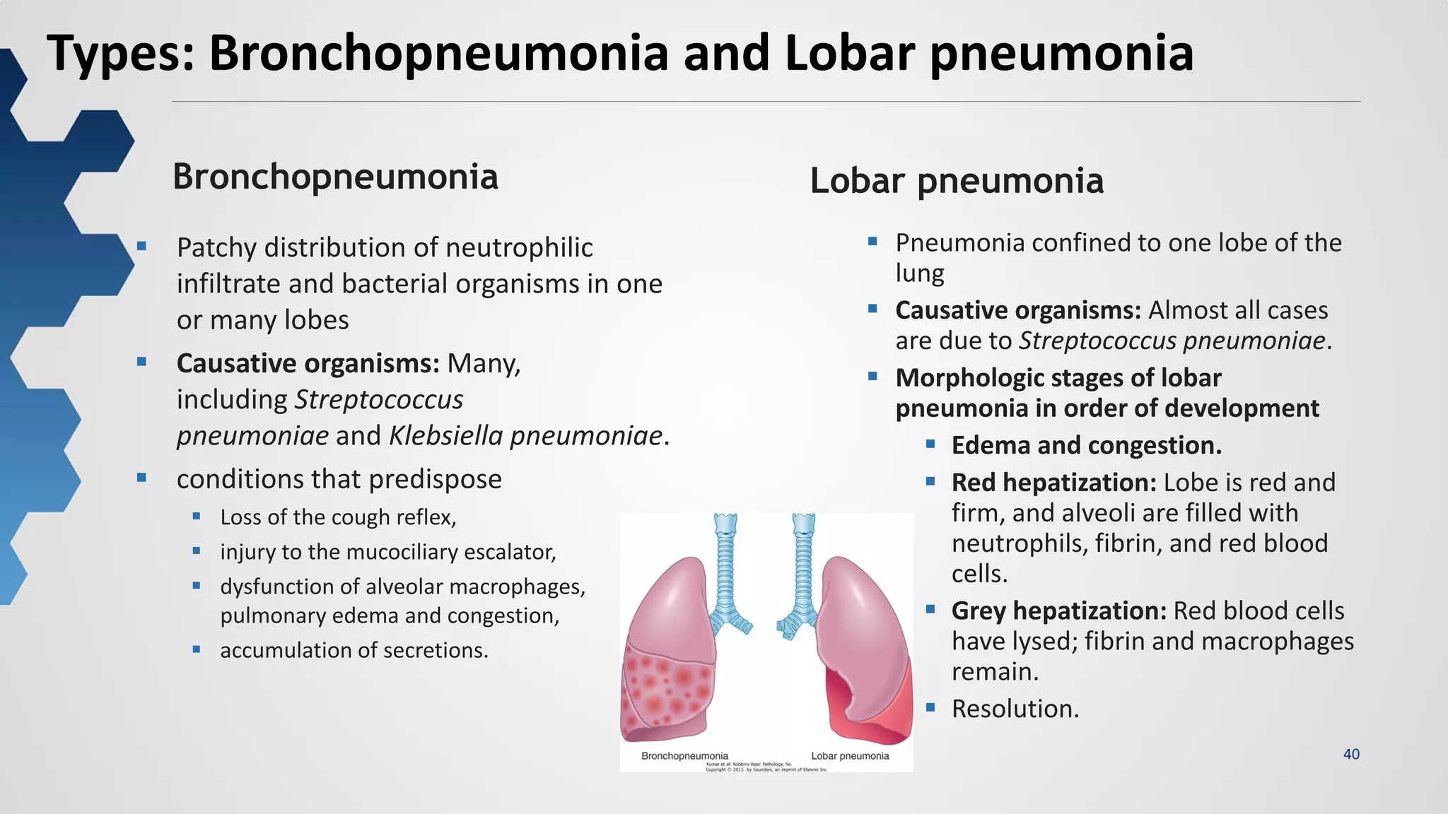 40
Types: Bronchopneumonia and Lobar pneumonia
Bronchopneumonia Lobar pneumonia
 Patchy distribution of neutrophilic
infiltrate and bacterial organisms in one
or many lobes
 Causative organisms: Many,
including Streptococcus
pneumoniae and Klebsiella pneumoniae.
 conditions that predispose
 Loss of the cough reflex,
 injury to the mucociliary escalator,
 dysfunction of alveolar macrophages,
pulmonary edema and congestion,
 accumulation of secretions.
 Pneumonia confined to one lobe of the
lung
 Causative organisms: Almost all cases
are due to Streptococcus pneumoniae.
 Morphologic stages of lobar
pneumonia in order of development
 Edema and congestion.
 Red hepatization: Lobe is red and
firm, and alveoli are filled with
neutrophils, fibrin, and red blood
cells.
 Grey hepatization: Red blood cells
have lysed; fibrin and macrophages
remain.
 Resolution.
 