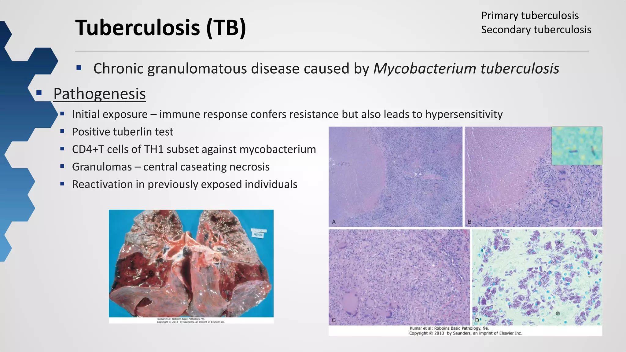 54
Tuberculosis (TB)
 Chronic granulomatous disease caused by Mycobacterium tuberculosis
 Pathogenesis
 Initial exposure – immune response confers resistance but also leads to hypersensitivity
 Positive tuberlin test
 CD4+T cells of TH1 subset against mycobacterium
 Granulomas – central caseating necrosis
 Reactivation in previously exposed individuals
Primary tuberculosis
Secondary tuberculosis
 
