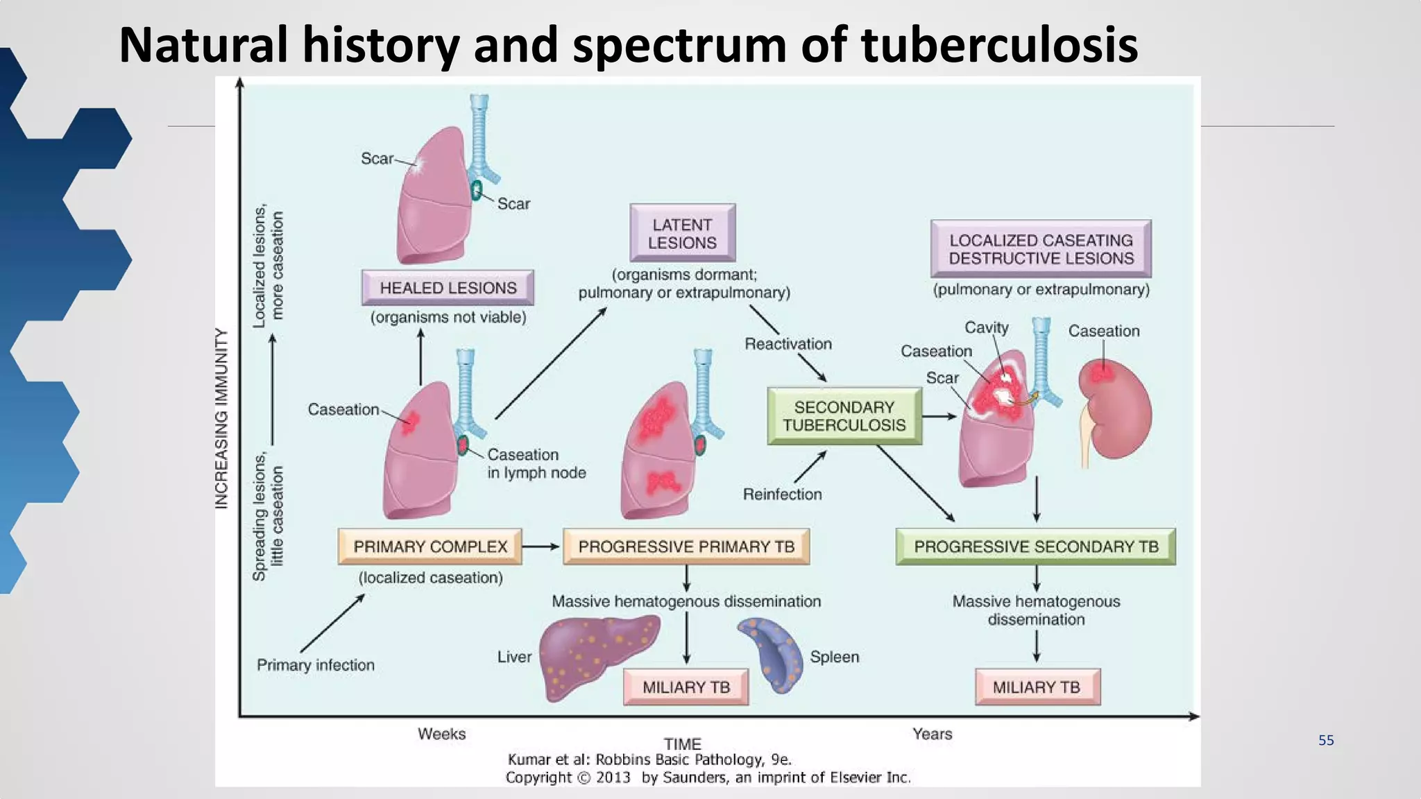 55
Natural history and spectrum of tuberculosis
 