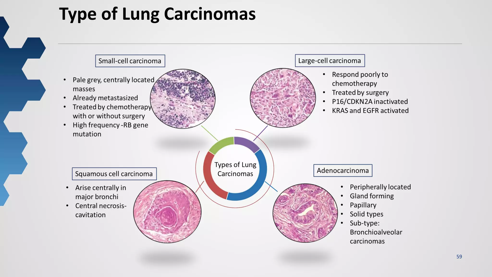 59
Type of Lung Carcinomas
 