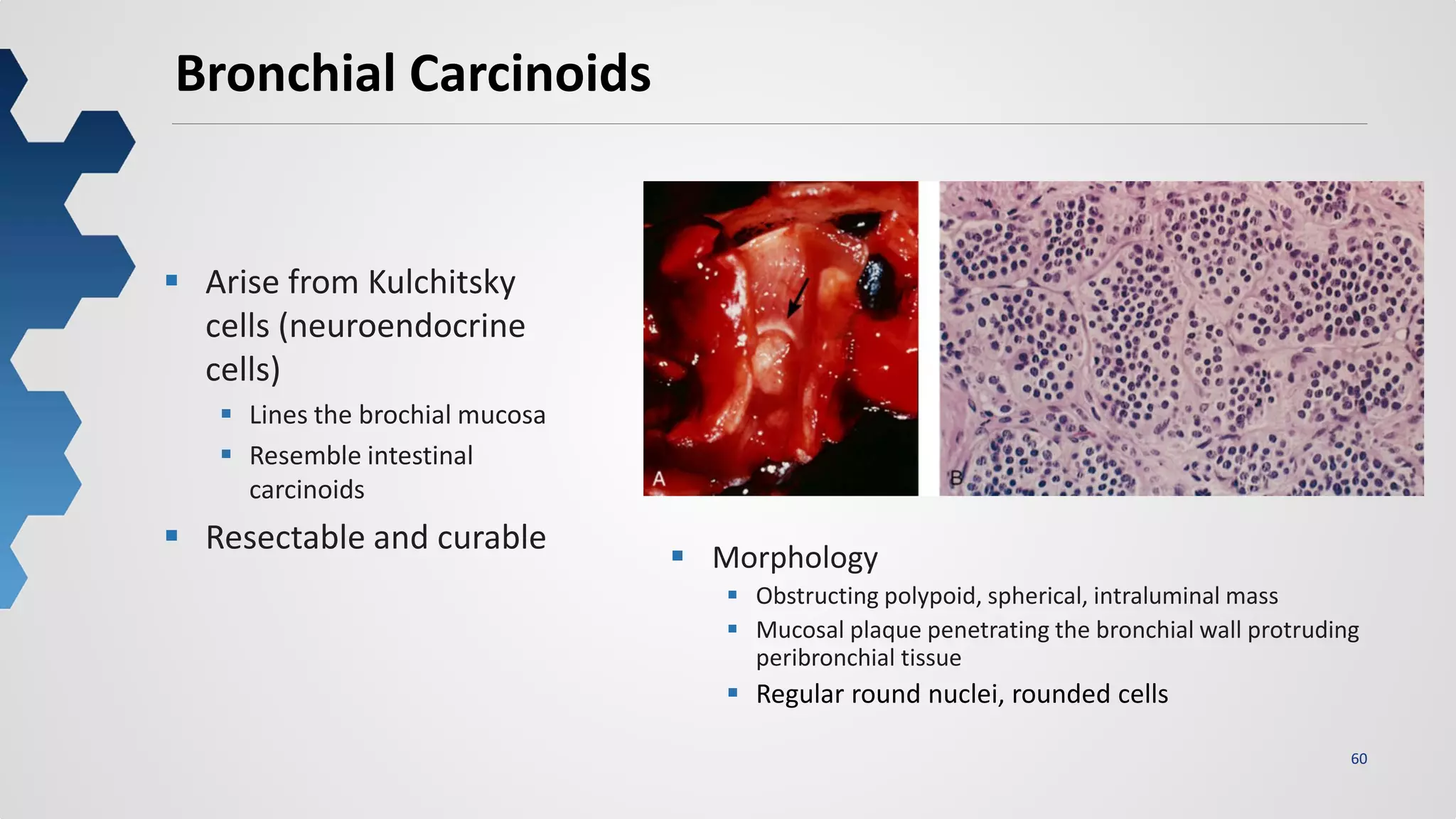 60
Bronchial Carcinoids
 Arise from Kulchitsky
cells (neuroendocrine
cells)
 Lines the brochial mucosa
 Resemble intestinal
carcinoids
 Resectable and curable
 Morphology
 Obstructing polypoid, spherical, intraluminal mass
 Mucosal plaque penetrating the bronchial wall protruding
peribronchial tissue
 Regular round nuclei, rounded cells
 