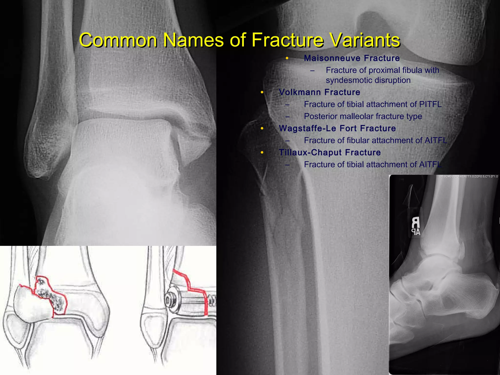 Lecture trauma ankle_fracture | PPT