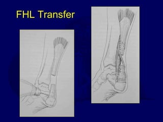 FHL Transfer 
 