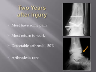  Most have some pain 
 Most return to work 
 Detectable arthrosis - 50% 
 Arthrodesis rare 
 