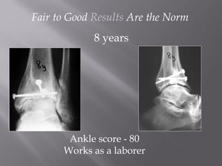 Fair to Good Results Are the Norm 
8 years 
Ankle score - 80 
Works as a laborer 
 