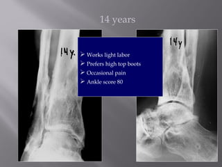 14 years 
 Works light labor 
 Prefers high top boots 
 Occasional pain 
 Ankle score 80 
 