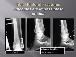 6.5 yrs - miserable - 
Case 2 ankle score 45 
 