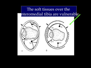 The soft tissues over the 
anteromedial tibia are vulnerable 
 
