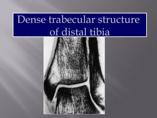 Dense trabecular structure 
of distal tibia 
 