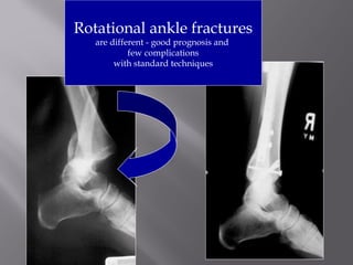 Rotational ankle fractures 
are different - good prognosis and 
few complications 
with standard techniques 
 