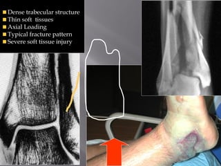 Dense trabecular structure 
Thin soft tissues 
Axial Loading 
Typical fracture pattern 
Severe soft tissue injury 
 