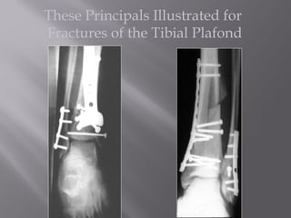 These Principals Illustrated for 
Fractures of the Tibial Plafond 
 