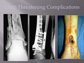 Limb Threatening Complications 
 